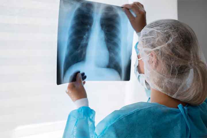 Tuberculose, doença infeciosa causada pela bactéria Mycobacterium tuberculosis - Imagem Freepik