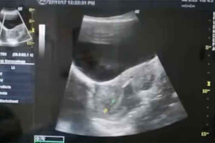 Fertilização in vitro