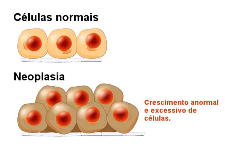 A Neoplasia cervical é uma condição caracterizada pelo crescimento desordenado de células na região do pescoço, que pode envolver estruturas como linfonodos, glândulas, tecidos musculares e órgãos próximos. 
