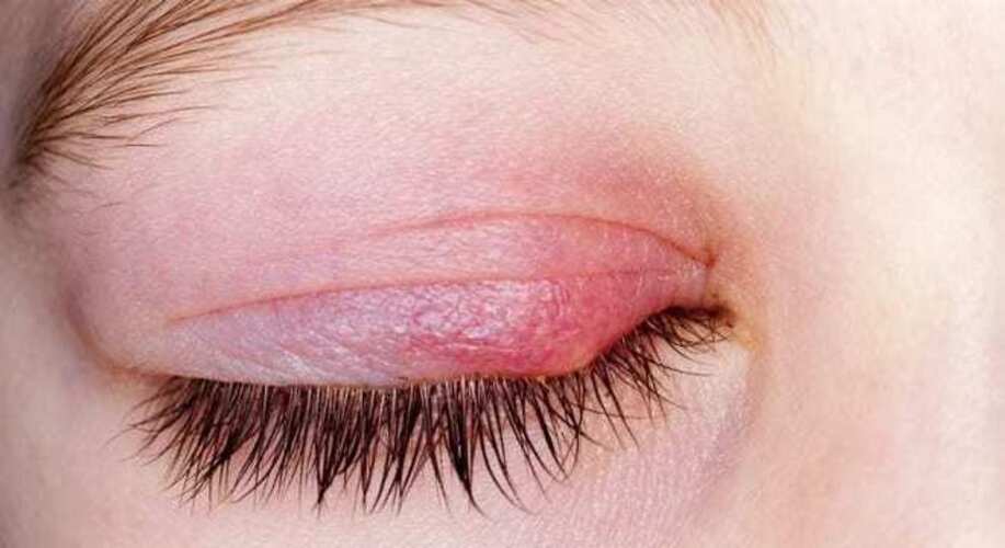 A exposição intensa à luz solar também pode provocar desconforto imediato, como dor, lacrimejamento e sensibilidade à luz. Diferentemente do mito do terçol, esses efeitos têm base científica e estão ligados à radiação ultravioleta e à intensidade da luz solar.