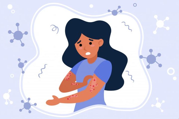 A catapora, também conhecida como varicela, é uma doença infecciosa causada pelo vírus varicela-zóster. Muito comum na infância, ela provoca febre, mal-estar e pequenas bolhas avermelhadas espalhadas pelo corpo, que causam intensa coceira. A transmissão acontece com facilidade por meio da saliva, da tosse, dos espirros e também pelo contato direto com as lesões na pele. Em ambientes fechados, o vírus pode se espalhar rapidamente entre pessoas que nunca tiveram a doença ou que não receberam vacin -  (crédito: Magnific/pch.vector)