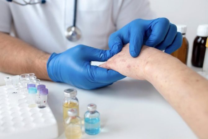 Como evitar a catapora: medidas básicas ajudam no controle da doença