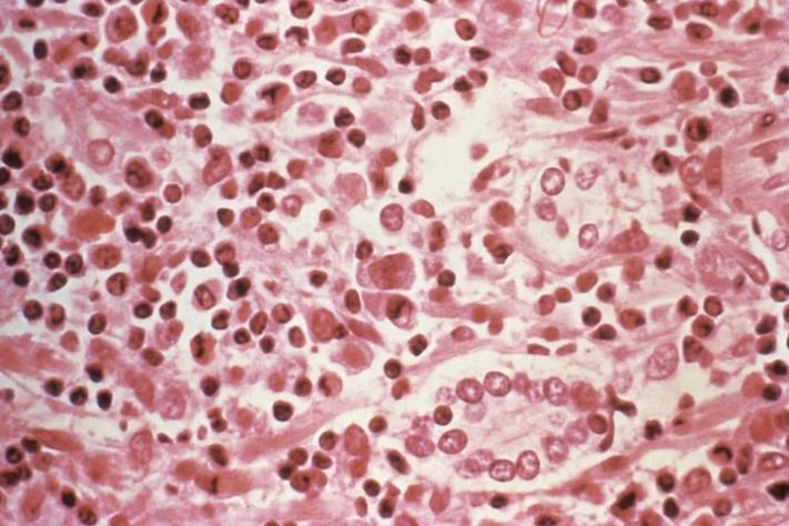 Estudo micrográfico de tecido hepático de um paciente com síndrome pulmonar por hantavírus - Centros de Controle e Prevenção de Doenças/Divulgação