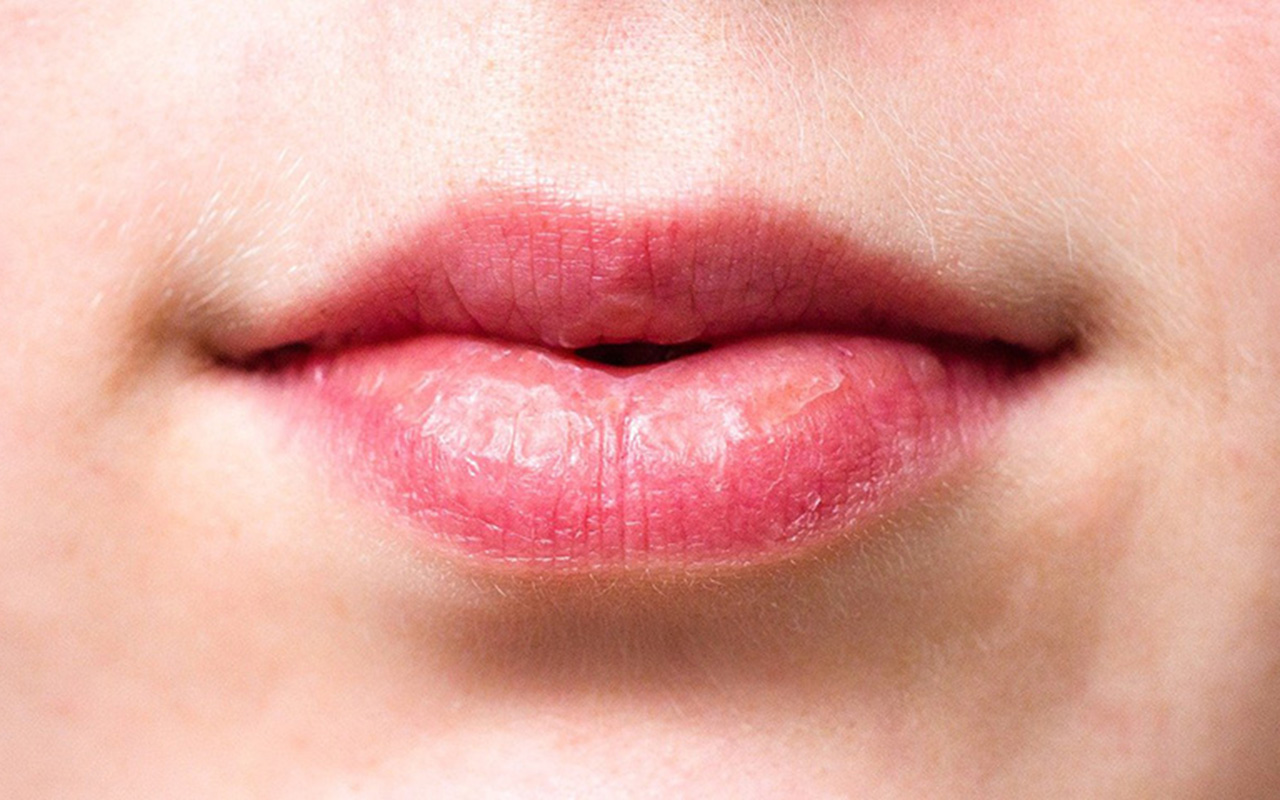 3 - Ajudar no tratamento do herpes: O própolis pode ser usado no tratamento do herpes labial e genital, pois ajuda a diminuir os sintomas e acelerar a cicatrização das lesões. Algumas pomadas contêm própolis em sua composição, mas estudos apontam que o própolis sozinho também ajuda na melhora dessa infecção se aplicado no local de 3 a 4 vezes por dia. Também ajuda contra futuras lesões por herpes.
