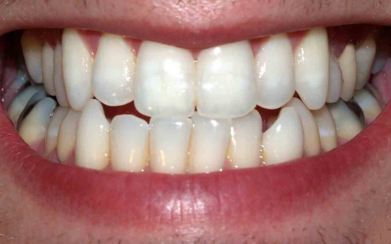 4 - Curar aftas e gengivites: Devido às suas propriedades antimicrobianas, o uso diário de própolis por via oral ajuda a combater e prevenir as aftas. No caso da gengivite, inflamação das gengivas, ajuda a prevenir e reduzir os sintomas da doença se usado como enxaguante ou em gel, além de ajudar no mau hálito.
