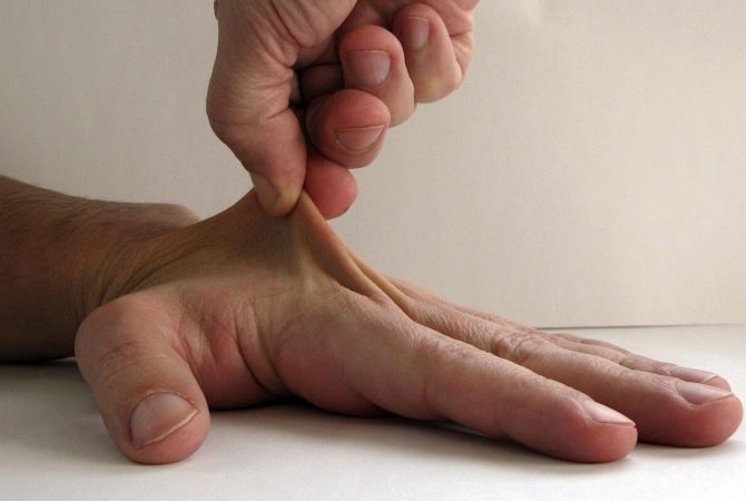 Síndrome de Ehlers-Danlos: doença genética rara afeta articulações e diagnóstico pode levar mais de 10 anos