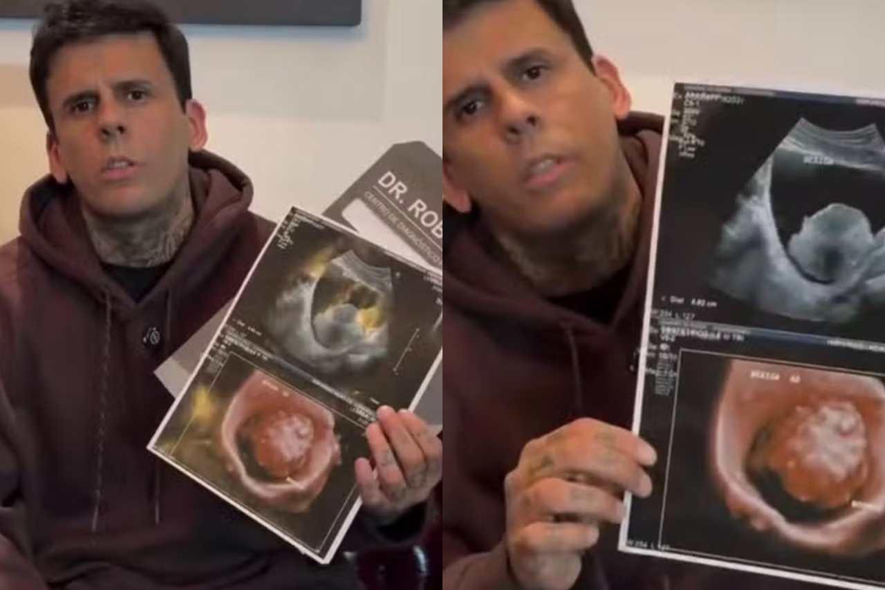 Uma nova sessão de remoção de tatuagens no rosto de Leandro de Souza, conhecido como 'o homem mais tatuado do Brasil', acabou suspensa após um exame de imagem revelar um tumor na bexiga. O procedimento seria a sétima etapa do tratamento e estava previsto para o dia 11 de agosto, em uma clínica de Franco da Rocha, na Grande São Paulo. -  (crédito: Reprodução/Redes Sociais
)
