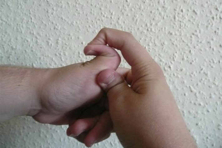 Síndrome de Ehlers-Danlos – Wikimedia Commons/Piotr Dołżonek