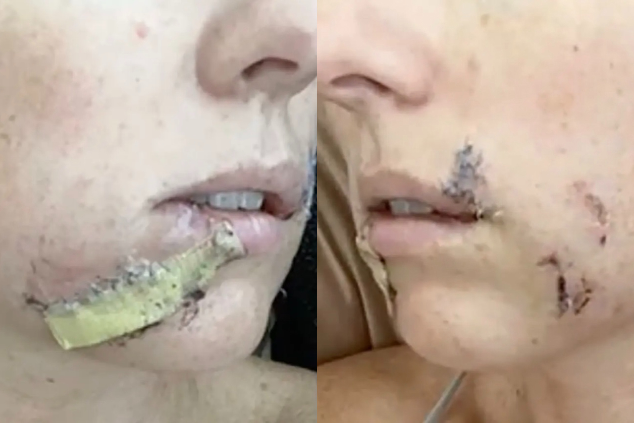 Brittany recebeu atendimento médico e precisou levar pontos ao redor da boca, além de ficar com ferimentos nos dois lados do rosto. Segundo ela, durante o ataque não sentiu dor, apenas a pressão provocada pela mordida. O caso foi o primeiro ataque de coiote registrado na região desde 2023, de acordo com as autoridades locais.