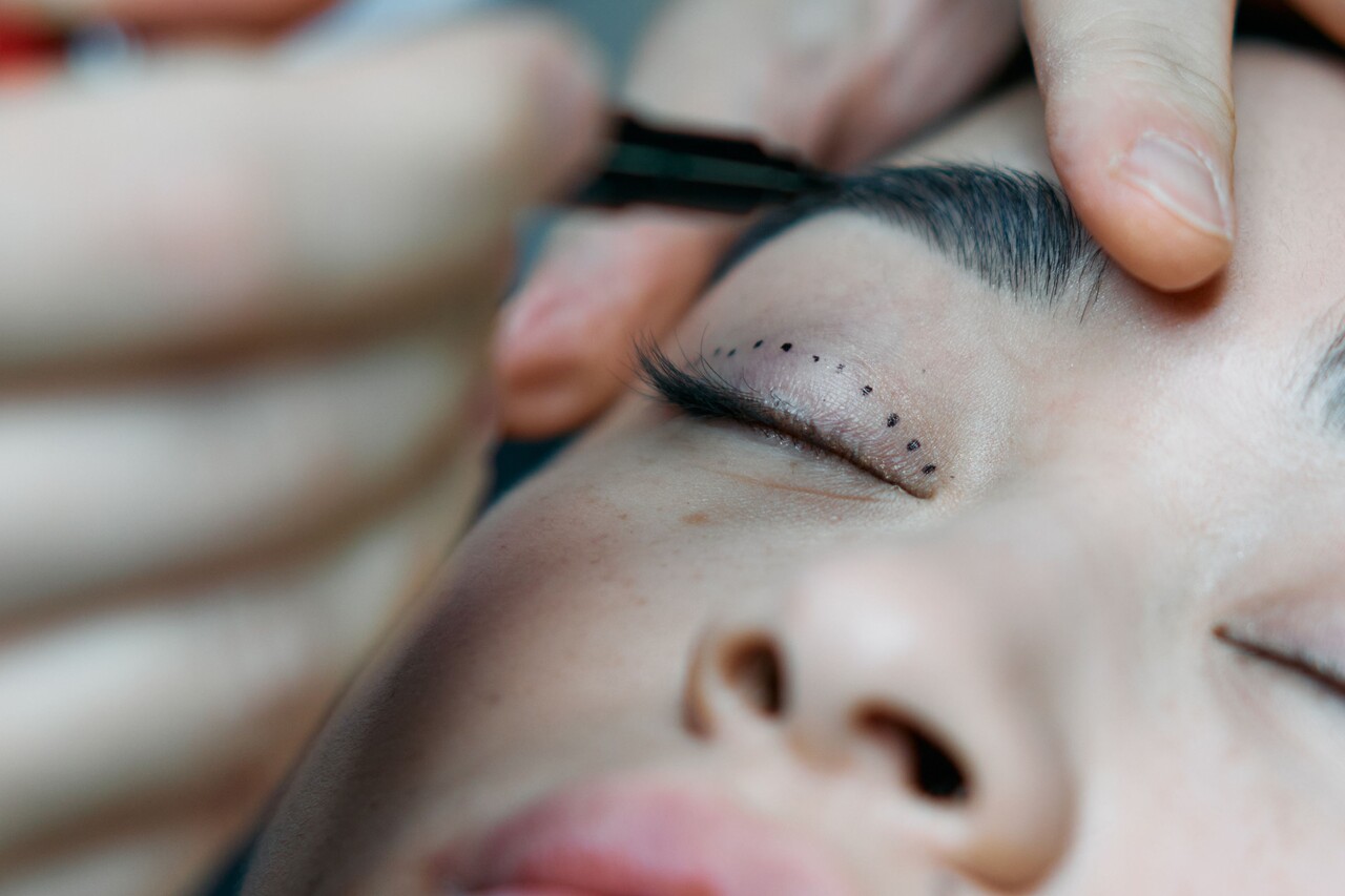 A atriz também relatou ter desenvolvido ceratite, uma inflamação que pode ocorrer devido ao ressecamento dos olhos após a cirurgia. A retirada excessiva de pele pode deixar a córnea exposta, inclusive durante o sono, aumentando o risco de ressecamento e de uma úlcera de córnea. Segundo Ribeiro, em casos graves, o problema pode levar à perfuração da córnea e exigir um enxerto de pele para fechar a pálpebra. 
