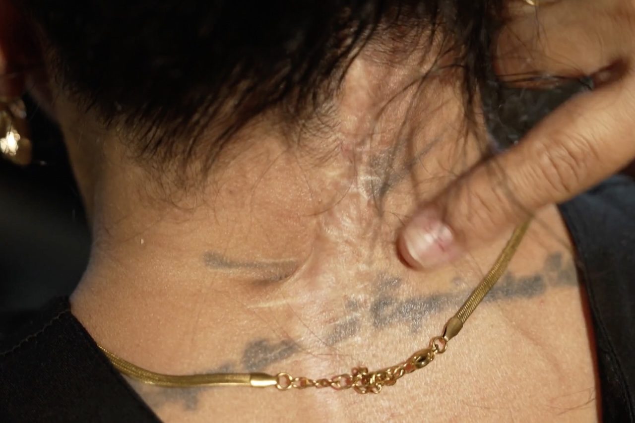 Em 2018, a professora Nathalia Assenjo Motta sofreu uma grave lesão cervical após um movimento de chicote e precisou colocar 12 pinos e duas hastes na região. Em 2014, um motoboy ficou tetraplégico após um acidente e morreu em 2023 por complicações relacionadas a uma infecção.