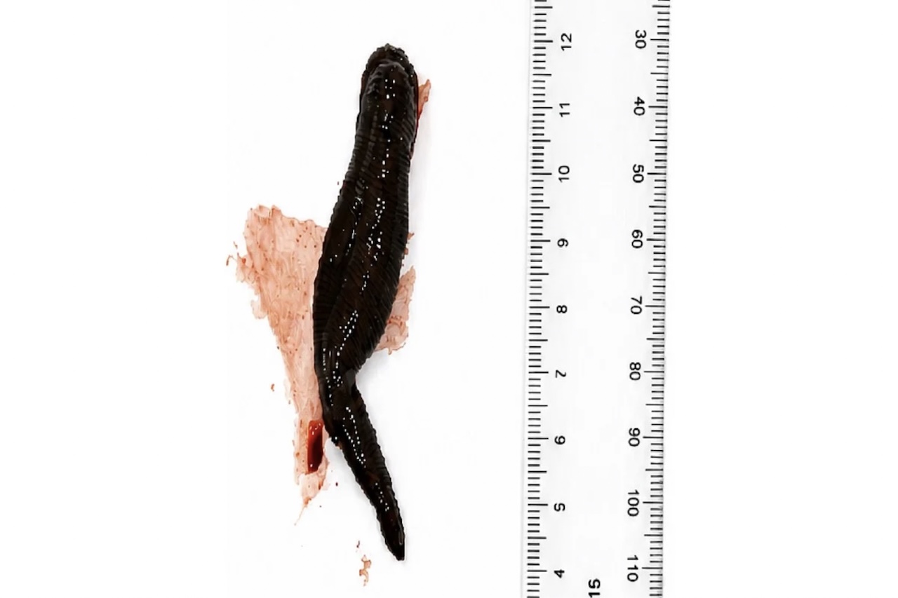 No hospital, os médicos descobriram uma sanguessuga de 8 centímetros presa à garganta da adolescente, provavelmente ingerida quando ela bebeu a água. O animal foi retirado com uma pinça, mas a menina apresentou anemia leve e precisou tomar ferro. 