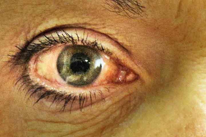 A doença é responsável pela perda de visão e considerada por especialistas a principal causa de cegueira no mundo. 