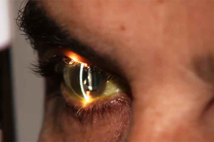 A degeneração macular relacionada à idade (DMRI) é outra condição que merece atenção, pois afeta a mácula, área central da retina responsável pela visão detalhada. A DMRI pode levar à perda progressiva da visão central, dificultando atividades como leitura e reconhecimento de rostos. -   Reprodução de Youtube Canal SBT News